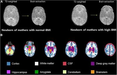 Maternal pre-pregnancy obesity affects the uncinate fasciculus white matter tract in preterm infants